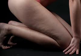cellulit2