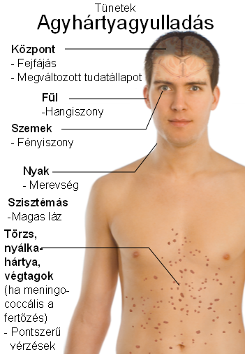 symptoms of meningitis hu