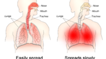 220px-H1N1_versus_H5N1_pathology