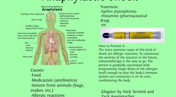 anaphylactic shock source