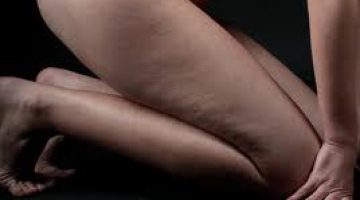 cellulit2