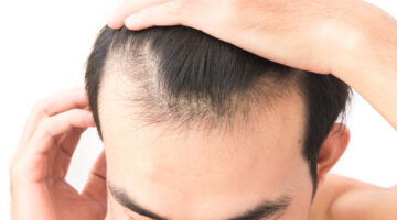 Young,Man,Worry,Hair,Loss,Problem,For,Health,Care,Shampoo