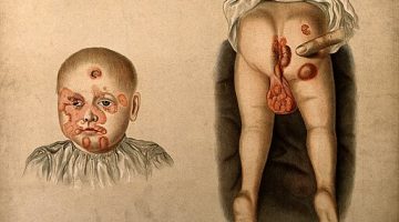 hereditary syphilis; lesions face, buttocks, genitals, 1850 wellcome v0010240