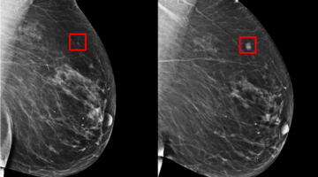 BreastCancerAI